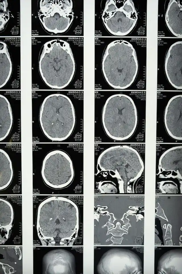 Can You Live A Normal Life After Brain Injury?