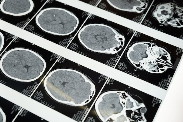 What Are The 3 Main Types Of Head Injury